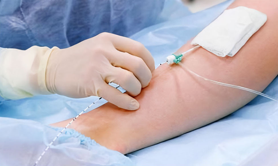 Endovenous Laser Treatment