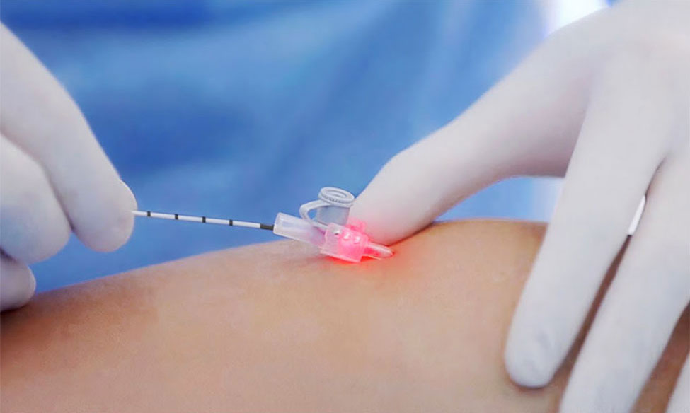 Endovenous Laser Treatment