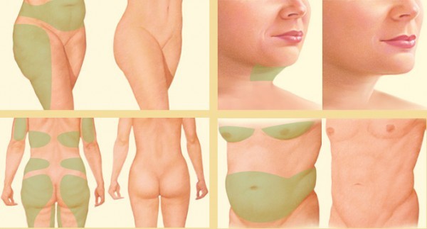 Laser Lipolysis Treatment Areas