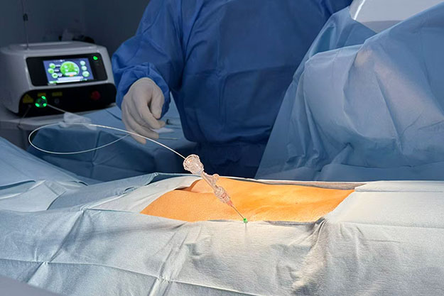 PLDD Laser Treatment