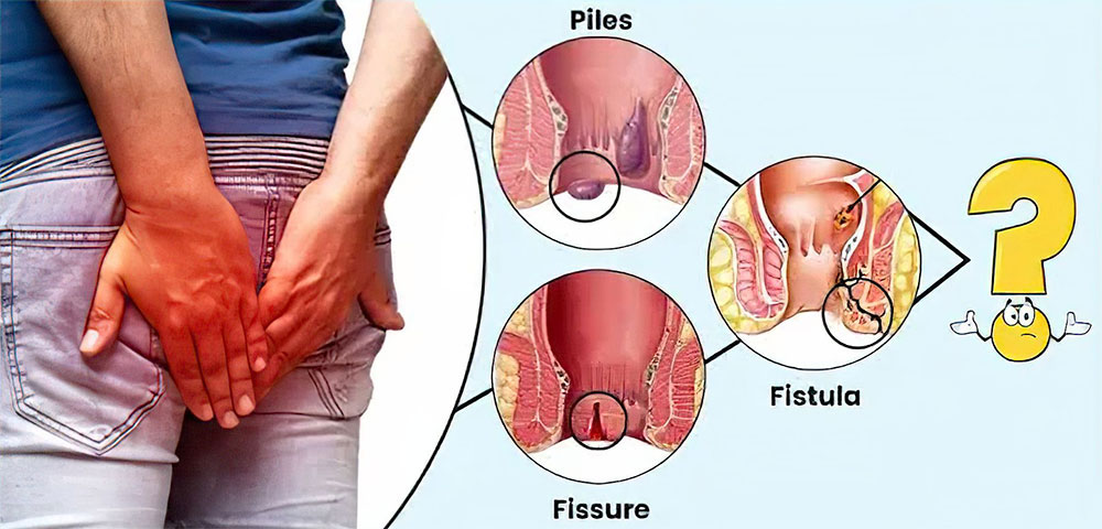 Laser Treatment in Proctology