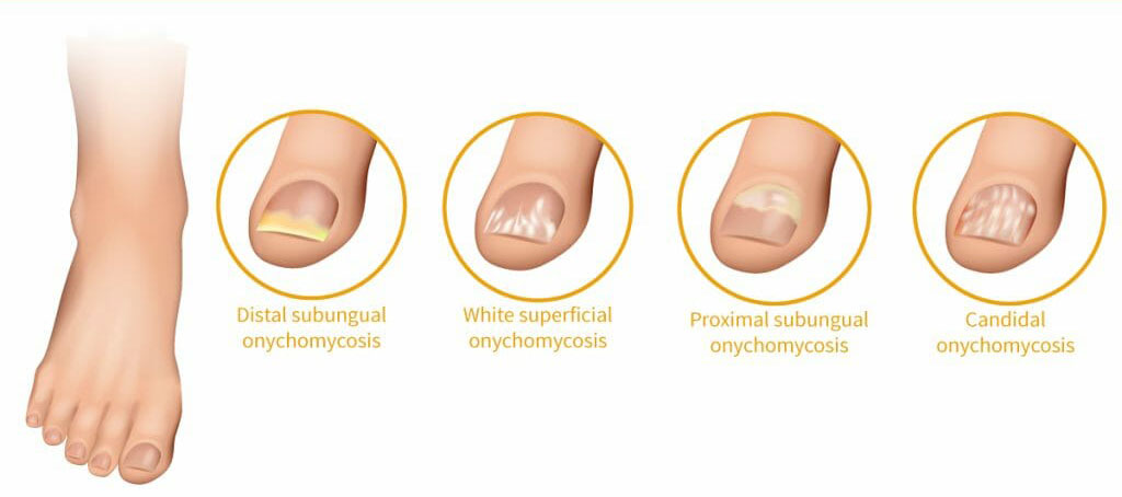 Types of Nail Fungal Infection