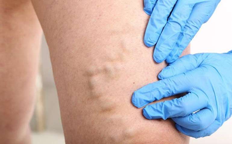 Endovenous Laser Treatment