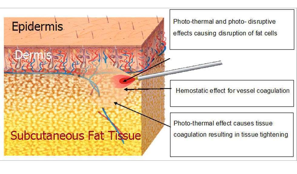 Laser Lipolysis