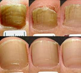 Laser Nail Fungus Therapy