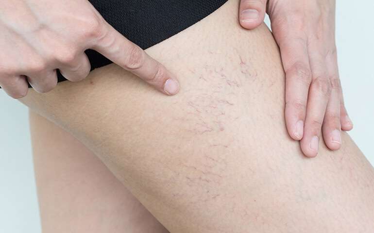 Laser Spider Vein Removal